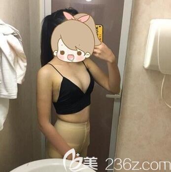 我在南宁东方整形做自体脂肪丰胸第7天拆线效果 我在南宁东方整形做自体脂肪丰胸第7天拆线效果