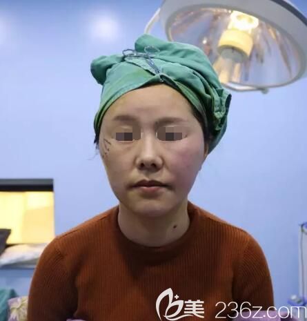 盐城东方陈锦添分享一侧脸做线雕效果对比 盐城东方陈锦添分享一侧脸做线雕效果对比