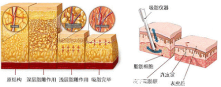 吸脂示意图