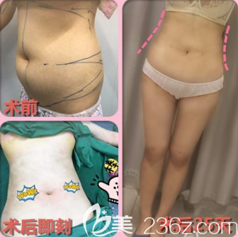 宝丽太吸脂的案例