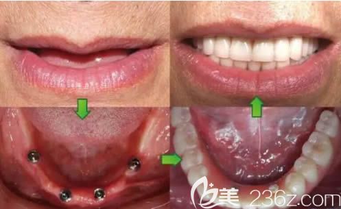北京维乐口腔医院周铭医生全口种植牙对比效果