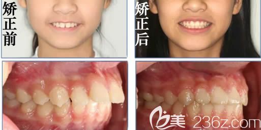 谭晖青少年龅牙矫正案例及脸型变化图 谭晖青少年龅牙矫正案例及脸型变化图