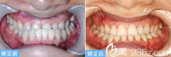 北京维乐口腔成人地包天矫正案例效果 北京维乐口腔成人地包天矫正案例效果
