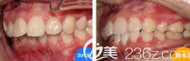 洛阳拜博口腔毕芳牙齿矫正案例