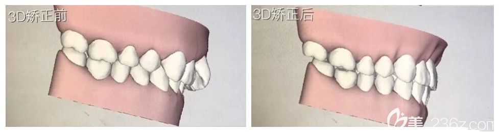 3D对比图，牙齿内收很多