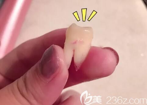 去洛阳拜博口腔矫正前拔掉的智齿