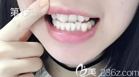 找洛阳拜博口腔毕芳矫正前第1天戴隐形牙套