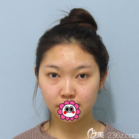 哈尔滨索菲做鼻综合前 哈尔滨索菲做鼻综合前