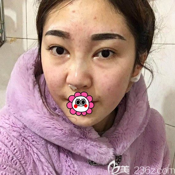 在哈尔滨索菲做完鼻综合即刻效果 在哈尔滨索菲做完鼻综合即刻效果