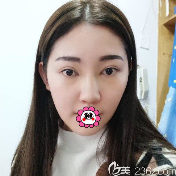 陈富全鼻综合术后第8天 陈富全鼻综合术后第8天