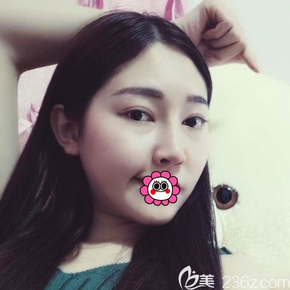 哈尔滨索菲鼻综合术后恢复一个月效果 哈尔滨索菲鼻综合术后恢复一个月效果