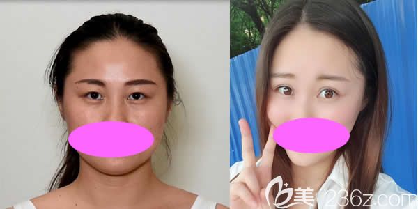 我在九江星瑞美割双眼皮前后