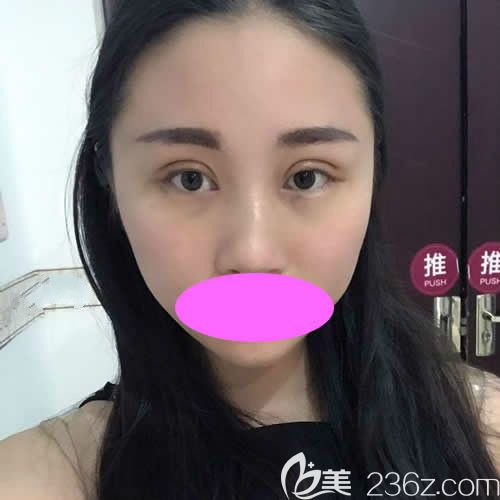 九江星瑞美双眼皮手术7天