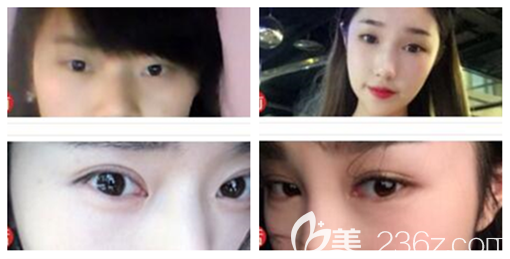 贵阳华美双眼皮怎么样 贵阳华美双眼皮怎么样