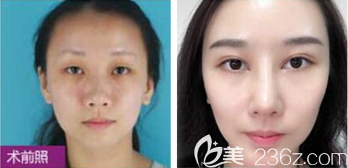 贵阳华美韩盛斌双眼皮案例 贵阳华美韩盛斌双眼皮案例