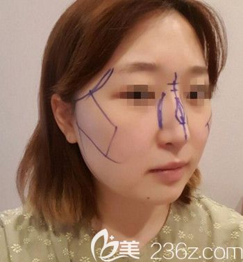 在韩国本爱做面部轮廓+鼻修复术前设计