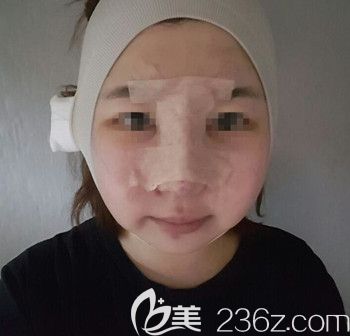在韩国本爱做面部轮廓+鼻修复术后2天