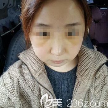 在韩国本爱做面部轮廓+鼻修复术后8天