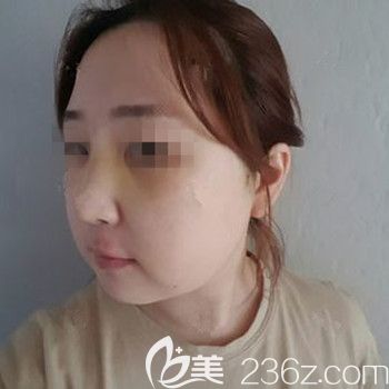 在韩国本爱做面部轮廓+鼻修复术后2周