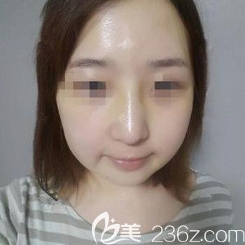 在韩国本爱做面部轮廓+鼻修复术后1个月