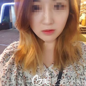 分享我找韩国本爱文圣昊院长做颧骨+下颌角+鼻修复手术3个月恢复全过程