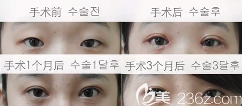 金成镐双眼皮真人案例 金成镐双眼皮真人案例