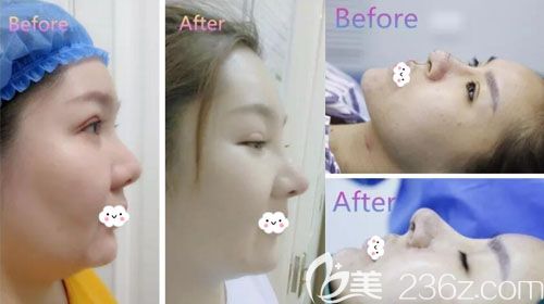 金成镐鼻综合隆鼻整形案例 金成镐鼻综合隆鼻整形案例