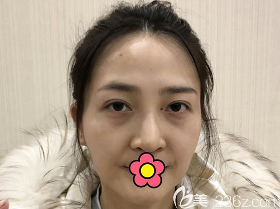 呼和浩特京美整形医院李发成面部脂肪填充前 呼和浩特京美整形医院李发成面部脂肪填充前