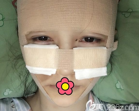 呼市京美李发成脸部脂肪填充第1天效果 呼市京美李发成脸部脂肪填充第1天效果