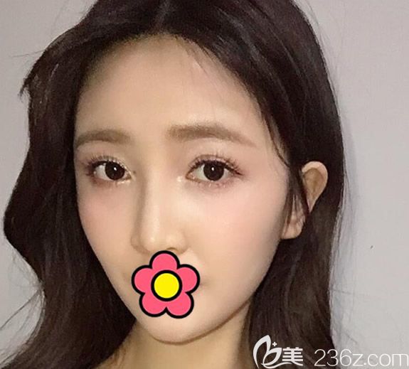 呼市京美李发成全脸脂肪填充第5天照片 呼市京美李发成全脸脂肪填充第5天照片