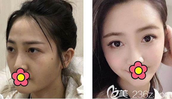呼和浩特京美整形医院全脸脂肪填充对比图 呼和浩特京美整形医院全脸脂肪填充对比图