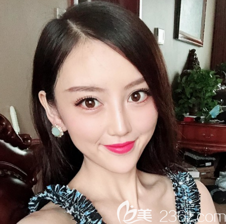 广州做埋线提升哪家医院好？看我花38000元找广州天姿做的悦升线雕提升效果怎么样？