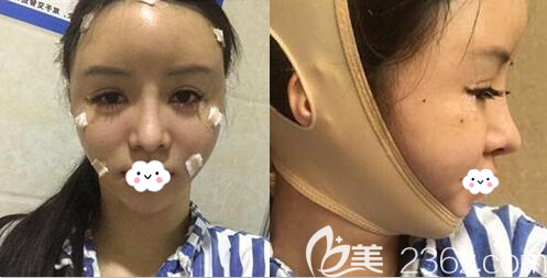 自体脂肪面部填充+面部吸脂术后即刻效果