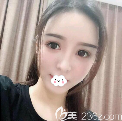 毛健清全面部脂肪填充术后3个月效果