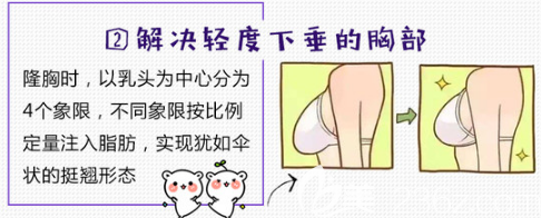 自体脂肪丰胸可以解决胸部的轻度下垂问题