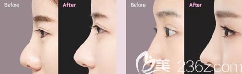 韩国原辰鼻综合手术案例 韩国原辰鼻综合手术案例