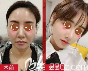 上海玫瑰医疗美容医院自体脂肪全脸填充真人案例