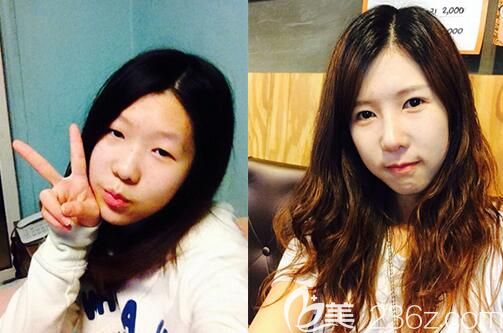 韩国YENJIN鼻综合手术案例 韩国YENJIN鼻综合手术案例