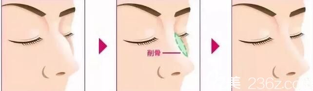 驼峰鼻矫正手术 驼峰鼻矫正手术
