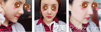 上海玫瑰医疗美容医院鼻综合+自体脂肪面部填充术后第七天