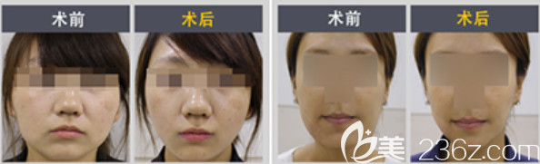 韩国hansen整形外科辛元宰院长面部吸脂真人案例