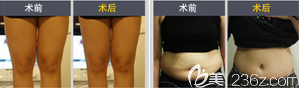 韩国hansen整形外<!--<i data=20240703-sp></i>-->腿吸脂与腰腹吸脂案例