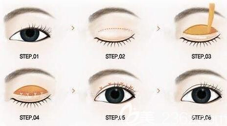 割完双眼皮后恢复期必须要熬过的5大阶段