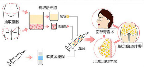 自体脂肪填充流程图