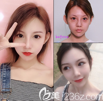 自体脂肪填充面部案例