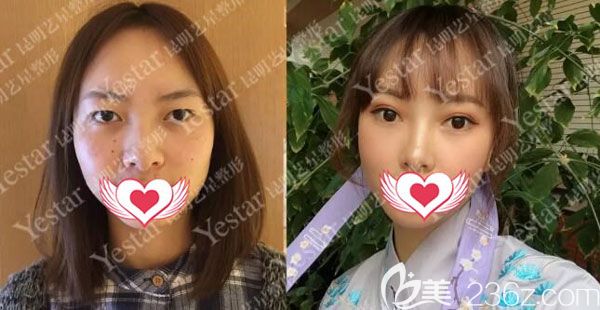 金辉做全切双眼皮三个月案例效果