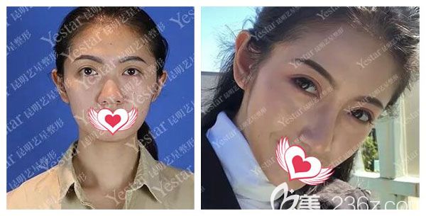 金辉做肋软骨隆鼻+耳软骨垫鼻尖案例效果