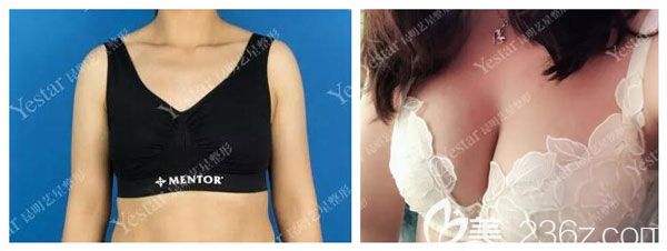 做硅胶假体隆胸案例效果对比图