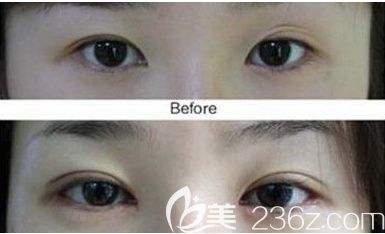 韩国成镇魔手术案例，双眼皮前后效果对比图