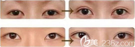 韩国成镇模胎式无痕双眼皮案例